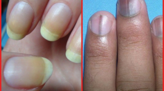 Thấy móng tay xuất hiện dấu hiệu này, cảnh báo căn bệnh nguy hiểm đang 'đứng chờ' trước cửa