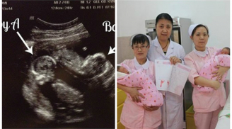 Bắt gặp sản phụ sinh 2 con cùng lúc nhưng bác sĩ lại nói 'đây không phải là cặp song sinh'