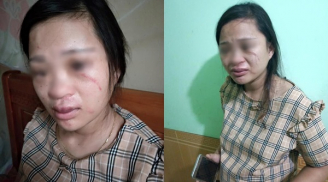 Thai phụ 8 tháng bị chồng túm tóc, đánh đập đến thâm tím người vì mua đôi giày 135k trên mạng