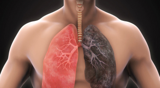 5 dấu hiệu cảnh báo ung thư phổi đang gõ cửa, nguy hiểm khó lường