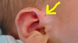 Thấy lỗ nhỏ ở vành tai kiểu này, đến gặp bác sĩ ngay vì căn bệnh nguy hiểm đang đứng ngay bên cạnh