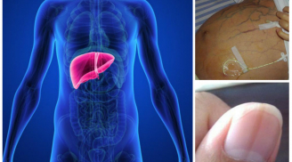 Thấy 4 điểm này càng 'đen': Hãy thận trọng ung thư gan đang “tấn công” cơ thể bạn