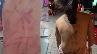 Xôn xao bé 6 tuổi bị bà đánh đập tàn bạo đến bầm tím khắp người