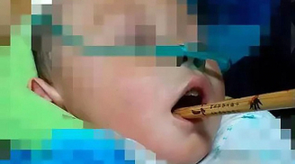 Đũa xuyên qua vòm miệng, chạm tới não bé gái 1 tuổi chỉ vì sơ suất của mẹ