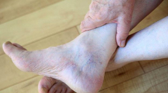 Bàn chân có dấu hiệu này hãy cảnh giác với ung thư gan
