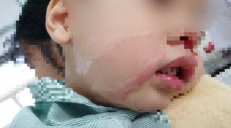 Vụ mẹ khiến con trai 2 tuổi bỏng nặng vì nhỏ nhầm axit: Lời cảnh báo cho các gia đình có trẻ nhỏ