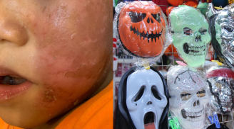 Bé trai 4 tuổi bỏng rộp da mặt sau khi đeo mặt nạ siêu nhân Halloween: Chuyên gia da liễu cảnh báo điều này