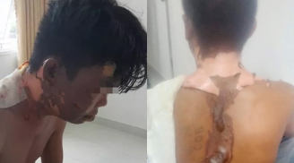 Nam thanh niên bị chị ruột đổ nước sôi lên đầu gây bỏng nặng: Hé lộ nguyên nhân bất ngờ