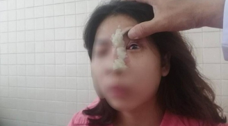 Tiêm filler nâng mũi ở spa gần nhà, cô gái trẻ bị mù mắt trái