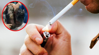 Hình ảnh lá phổi đen kịt của bệnh nhân sau 30 năm hút thuốc lá: Xem xong còn ai dám hút thuốc?