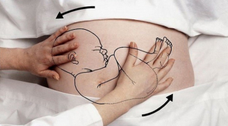 Xem bác sĩ dùng tay xoay thai nhi ngôi ngược trong bụng mẹ