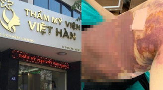 Lại thêm cô gái trẻ bị bỏng da đùi, biến dạng chân sau khi hút mỡ ở Thẩm mỹ viện Việt Hàn