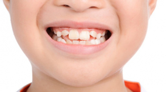 Những thói quen tai hại khiến răng trẻ mọc lệch: Điều cuối cùng là dễ mắc phải nhất