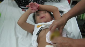 Sợ đến viện nhiễm Covid-19, hai bé trai nguy kịch vì vỡ ruột thừa