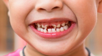 5 món ăn vặt hấp dẫn nhưng nằm trong danh sách 'đen', ảnh hưởng đến men răng của trẻ