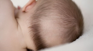 Rụng tóc ở trẻ nhỏ có phải biểu hiện trẻ bị suy dinh dưỡng hay không?
