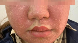 Đắp mặt nạ làm trắng da giá 600.000 đồng mua trên mạng, cô gái nhập viện với gương mặt chi chít mụn mủ