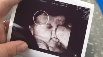 Mẹ sốc khi bác sĩ chỉ mảng sáng lạ trên đầu thai nhi, bé sinh ra càng gây bất ngờ hơn