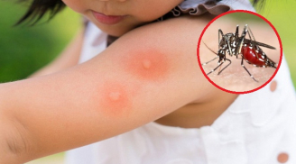 Mẹo trị muỗi đốt cho trẻ cực hiệu quả, mẹ bỉm sữa nào cũng cần biết