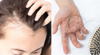 6 thói quen tai hại khiến tóc rụng từng mảng, chưa đều 30 tuổi đã hói đầu, nhiều người Việt vẫn làm mỗi ngày