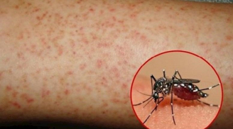 Thanh niên 17 tuổi mắc sốt xuất huyết t.ử v.ong do truyền dịch tại nhà