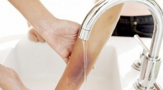 Các biện pháp ngăn ngừa hình thành sẹo bỏng đơn giản ngay tại nhà