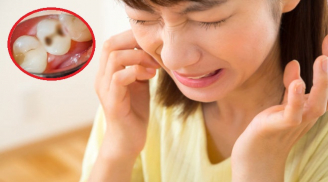Bác sĩ Bệnh viện Việt Đức chia sẻ biện pháp ngừa sâu răng đơn giản, ai cũng làm được