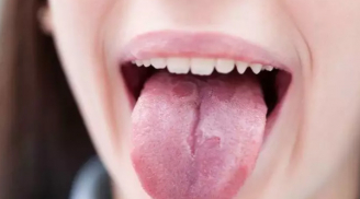 Nhà khoa học chỉ rõ: Dấu hiệu nhận biết COVID-19 qua lưỡi