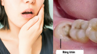 10 cách giảm đau khi mọc răng khôn hiệu quả tại nhà