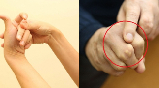 Bẻ khớp ngón tay để giãn gân cốt: Tưởng vô hại nhưng gây ra 1 căn bệnh đáng sợ