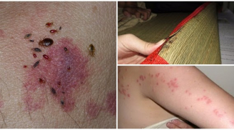 Rệp giường lọt top côn trùng nguy hiểm nhất TG, gây nhiễm trùng máu: Giặt chiếu không hết, phải khéo trị bằng cách khác