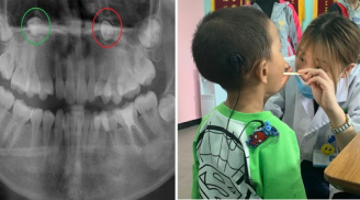 Con 8 tuổi vẫn không thay chiếc răng nào, Bs mắng mẹ: Cứ ở nhà thì không có răng vĩnh viễn luôn