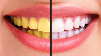 8 cách làm trắng răng tự nhiên đơn giản ngay tại nhà