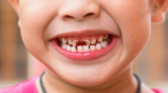 Bé 4t phải nhổ 15 răng sữa sâu mục nát: BS nói răng vĩnh viễn cũng khó đều đẹp, các mẹ nhớ 1 điều