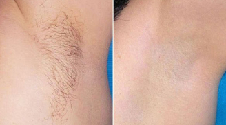 5 cách triệt lông tại nhà bằng nguyên liệu tự nhiên, vừa an toàn vừa hiệu quả