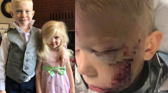 Xả thân cứu em gái khỏi chó dữ, cậu bé 6 tuổi phải khâu 90 mũi: Gương mặt hiện tại gây xúc động mạnh
