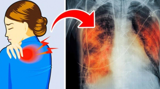 Tự kiểm tra sức khỏe của phổi thông qua 6 dấu hiệu: Xuất hiện 1 điểm cũng đáng lo ngại, cần điều trị gấp
