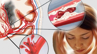 3 thói quen có thể gây đột quỵ vào buổi sáng, nhất là loại thứ 2 cẩn thận kẻo nguy hiểm tính mạng