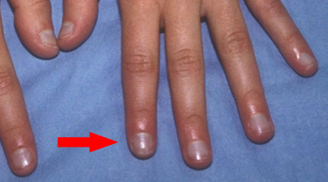 6 triệu chứng trên ngón tay cảnh báo có bệnh trong người: Cẩn thận gan và phổi đang kêu cứu