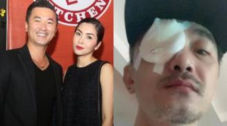 Nam diễn viên 'Dốc Tình' - tri kỷ của Hà Tăng bị chấn thương phải băng một bên mắt