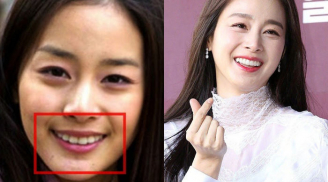 Sao Hàn lên đời nhan sắc nhờ chỉnh răng, đến Kim Tae Hee cũng không ngoại lệ