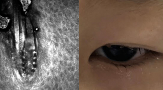 Dụi mắt đến trụi mi, bé gái 10 tuổi được đưa đến viện phát hiện 21 con bọ ve ký sinh trên mí