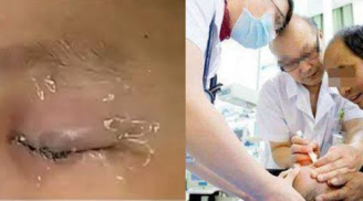 Con nhỏ keo 502 vào mắt, ông bố bình tĩnh làm 1 việc được bác sĩ khen hết lời: May giữ được mắt con