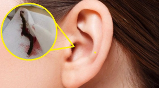 Rết dài 5 cm 'làm tổ' trong tai người phụ nữ, bác sĩ nhìn cũng thấy 'hết hồn'