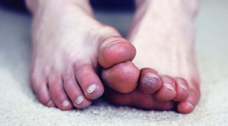 Tay chân lạnh có thể là dấu hiệu của 6 bệnh nguy hiểm, trong đó có tai biến, suy thận