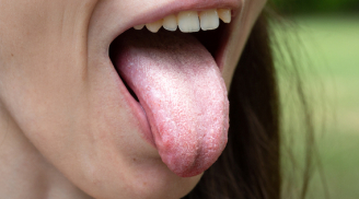 Lưỡi có 1 trong 5 biểu hiện sau là dấu hiệu của bệnh: Thấy lưỡi chuyển vàng, tím phải coi chừng