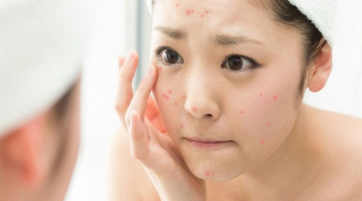 Xóa tan nỗi lo mụn tuổi dậy thì với một vài cách đơn giản dễ làm sau