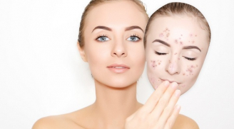 Tất tần tật các kiến thức về việc điều trị mụn cho làn da khô bạn cần lưu ý