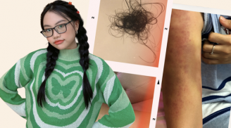Phương Mỹ Chi hé lộ loạt ảnh tay chân bầm tím, rụng tóc nghiêm trọng ở tuổi 18