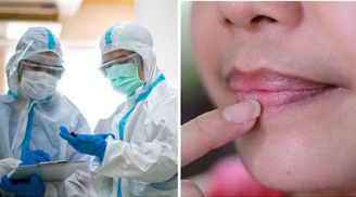 Triệu chứng nhiễm Omicron đặc trưng trên da, môi và móng tay: Phát hiện sớm sẽ tự cứu mình